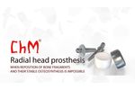 ChM Radial Head Prosthesis - Video