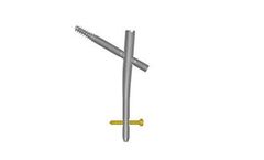 TREU FIDES - Trochanteric Nail System
