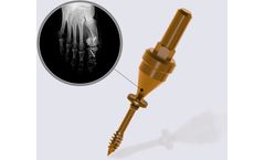 DynafitSystem - Snap-Off Self-Compressive Screws for Weil Osteotomies