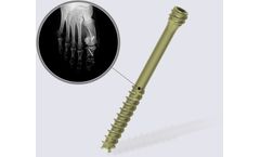 DynafitSystem - Self-Compressive Screw