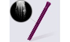 DynafitSystem - Neutralization Screws