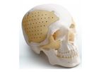Medprin Recranio - Cranio-Maxillofacial Repair System
