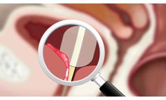 Foley Balloon Catheter ??? High Flow !!!SUBSCRIBE!!! - Video