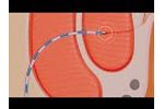 Radiofrequency ablation of anal fistulas - Fistura procedure (F Care Systems) - Video