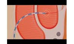 Radiofrequency ablation of anal fistulas - Fistura procedure (F Care Systems) - Video