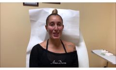 Patient Testimony after 4D Under Eye Lift as part of a non-surgical facelift (Liquid Facelift) - Video
