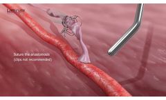 Laminate Medical Technologies - VasQ Device _ Short - Video