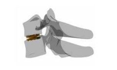 Cervical Disc Prothesis