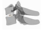 Cervical Expandable Cage
