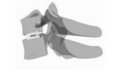 Cervical Expandable Cage