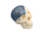 Titanium Mesh System for Skull Reconstruction