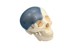 Titanium Mesh System for Skull Reconstruction