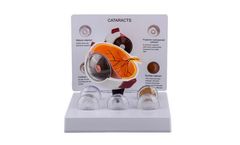 Pro-Health - Model PH14-002 - Oversized Human Cataract Eye Anatomy Model for Patient Education