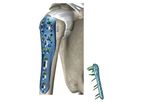 Sorath - BCP Proximal Humerus Proton Plate