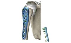 Sorath - BCP Proximal Humerus Proton Plate
