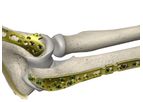 Sorath - Elbow Plating System
