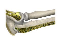 Sorath - Elbow Plating System
