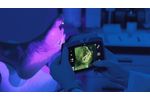 FLUORESCENCE IMAGING of wounds with the MolecuLightDX - Video