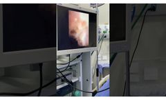 Prostate OVM6946 - Video