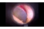 High Def Video Otoscope DE500 by Firefly.avi - Video