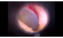 High Def Video Otoscope DE500 by Firefly.avi - Video