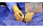 Angio-Seal VIP Locate Arteriotomy - Video