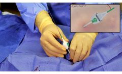 Angio-Seal VIP Locate Arteriotomy - Video