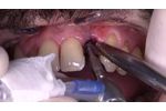 Immediate implantation and loading after extraction on lateral incisor - Video
