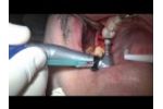 Immediate Placement MIS SEVEN Implants - Live Surgery - Video