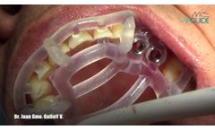 MGUIDE with C1 B+ Implants - Video