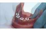 Sterngold Dental`s MOR Mini Implant System - Video