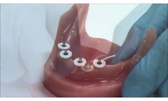 Sterngold Dental`s MOR Mini Implant System - Video