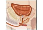Memokath - Model 045 Bladder Neck - Non-Allergenic Metallic Stent
