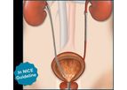Memokath - Model 051 Ureter - Non-Allergenic Metallic Stent