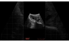 Advanced Ultrasound Scan - Video