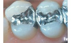 EPA will propose rule to protect waterways by reducing mercury from dental offices / existing technology is available to capture dental mercury (DC)