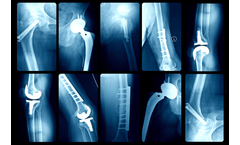 X-ray Photoelectron Spectroscopy (XPS) for Biomaterials